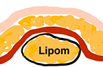 Lipom