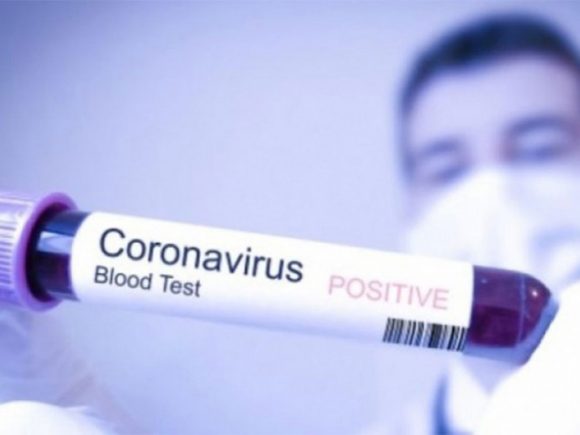 IZJ: Korona virus registrovan kod 245 osoba