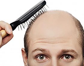 Otkrivena tehnika rasta nove kose