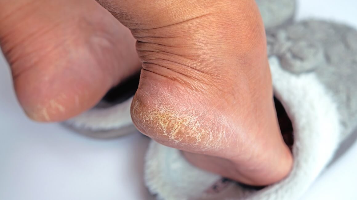 suha i ispucana stopala