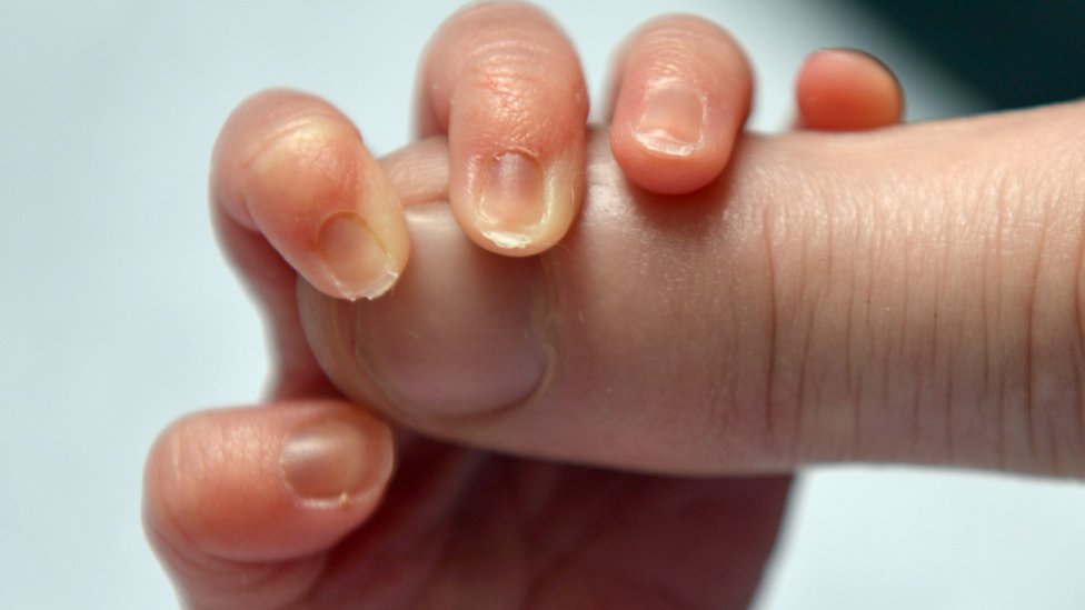 Japanski naučnici pronašli način za uklanjanje uzroka Daunovog sindroma