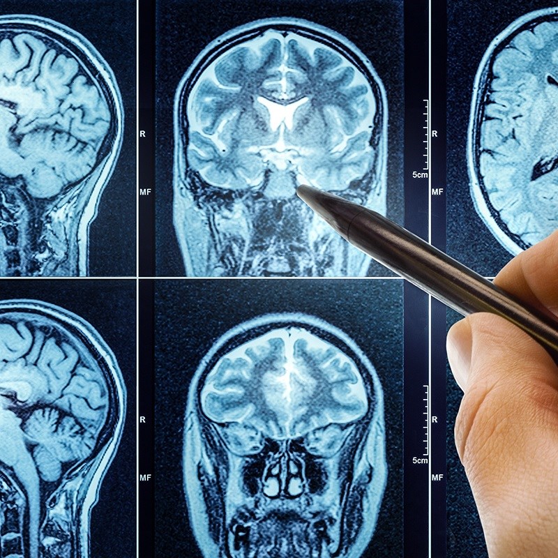 Naučnici napravili važan korak u mapiranju razvoja ljudskog mozga