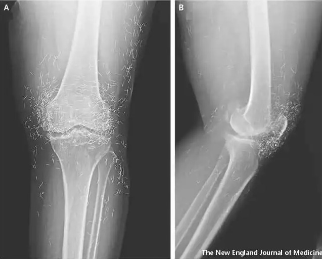 Zlatne niti u koljenima